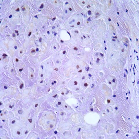 File:Brachyury.chordoma.jpg