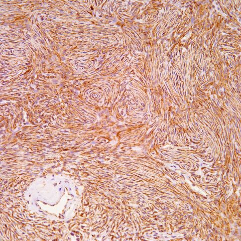 File:Claudin-1.perineurioma.200x.1.1..jpg