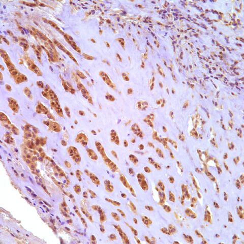 File:S100.myoepithelioma.parachordoma.4.jpg