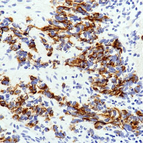 File:Keratin.desmoplastic small round cell tumor.1.jpg