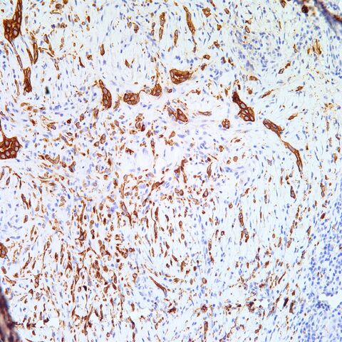 File:AE1-3.cytokeratin.mesothelioma.1.jpg