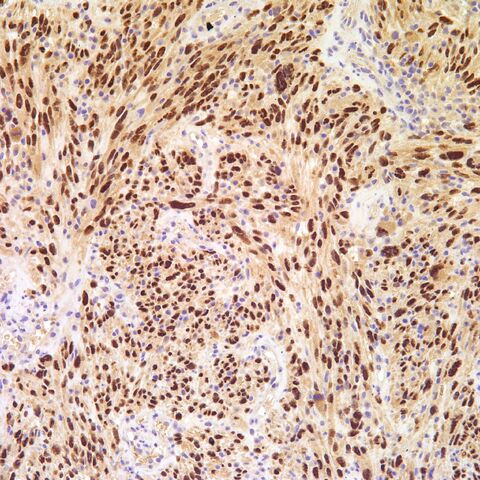 File:Sox10.melanoma.1.jpg