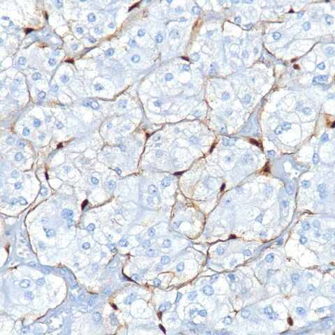 File:S100.paraganglioma.sustentacular.1.jpg