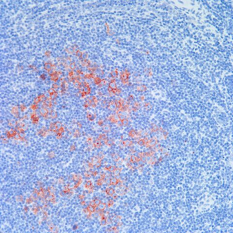 File:CD30.Hodgkin.jpg