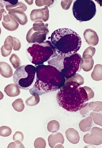 File:Faggot cell in AML-M3.jpg