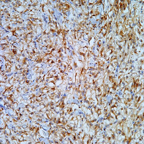 File:CD68.cutaneous pecoma.200x.jpg