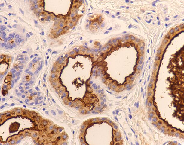 File:EMA.breast.early apocrine met maybe.400x.jpg