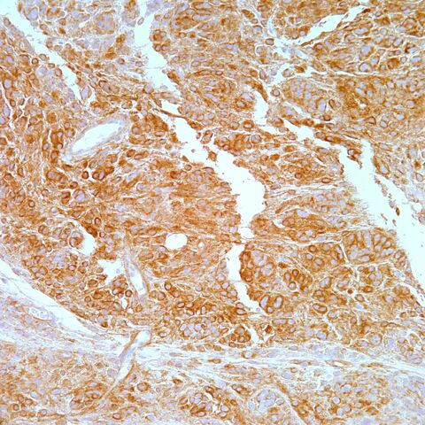 File:Type IV collagen.epithelioid schwannoma.4.jpg