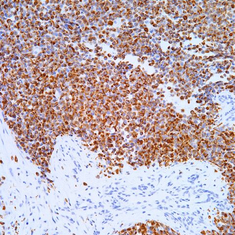 File:Desmin.alveolar rhabdomyosarcoma.2.jpg