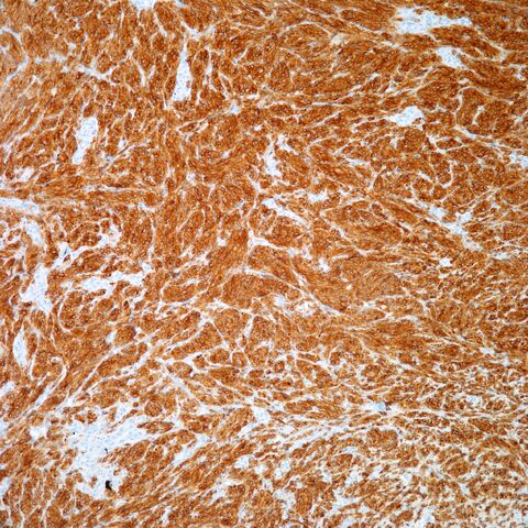 File:Melan-A.cellular blue nevus.jpg