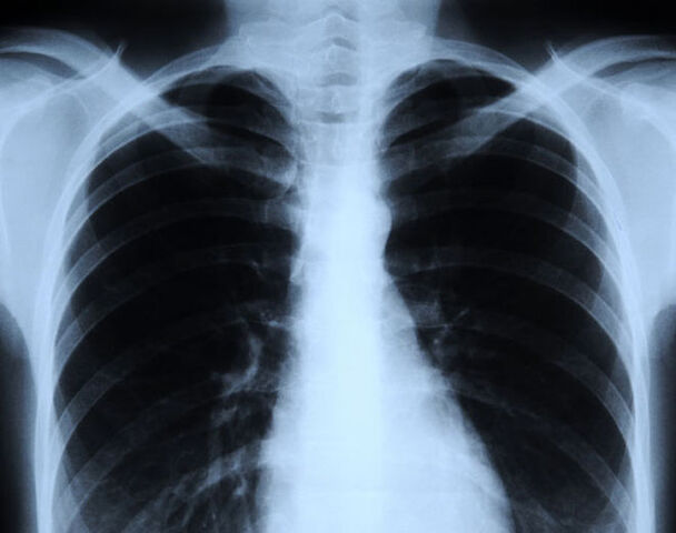 File:X-ray.jpg