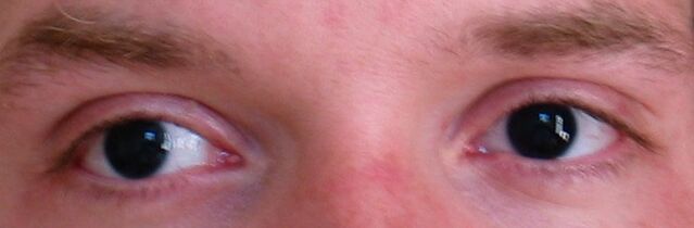 File:BlackEyesAniridia.jpg