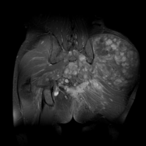 File:Neurofibroma in the hip.png