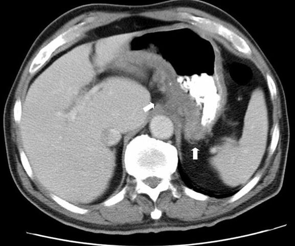 File:CT scan gastric CD.jpg