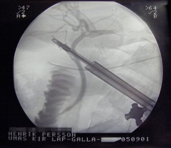 File:Laprascopy-Roentgen.jpg