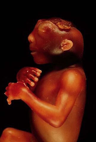 File:Anencephaly side.jpg