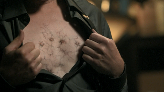 File:1x07 Druitt Electroshock marks.png
