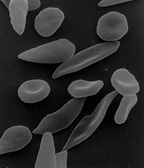 Sicklecells