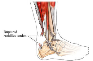 Ruptured-Achilles-Tendon-goog.jpg