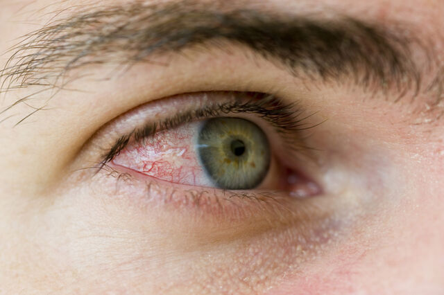 File:Bloodshot eye.jpg