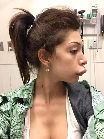 File:Farrah's botched lip surgery.jpeg
