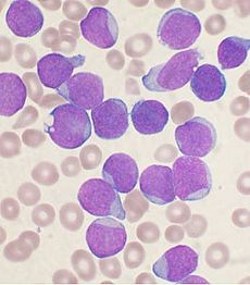 File:Leukemia.jpg