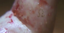 Isabellabirthmark1