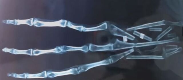 File:Cusco hand x ray.jpg