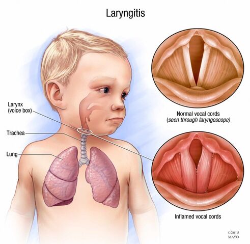 File:Laryngitis.jpg