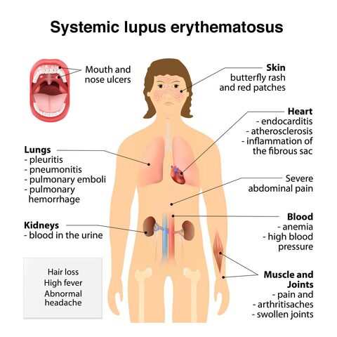 File:Lupus-symptoms.jpg