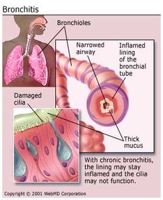 Understanding bronchitis basics bronchitis