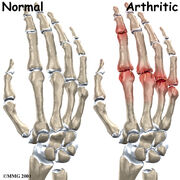 Hand finger joint causes01