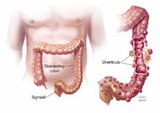 Diverticula
