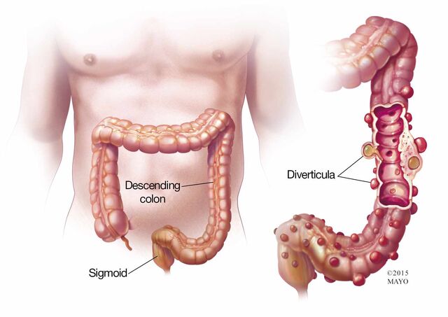 File:Diverticula.jpg