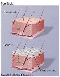 Understanding psoriasis basics