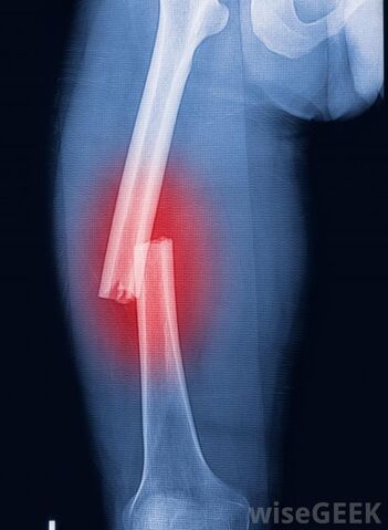File:X-ray-of-broken-thigh-bone.jpg