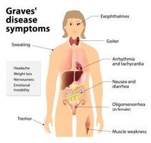 Symptoms-of-graves-disease
