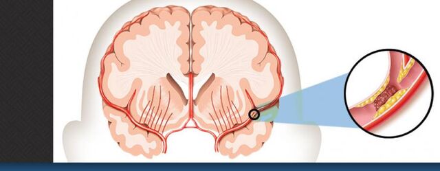 File:What-is-stroke-horiz 0.jpg