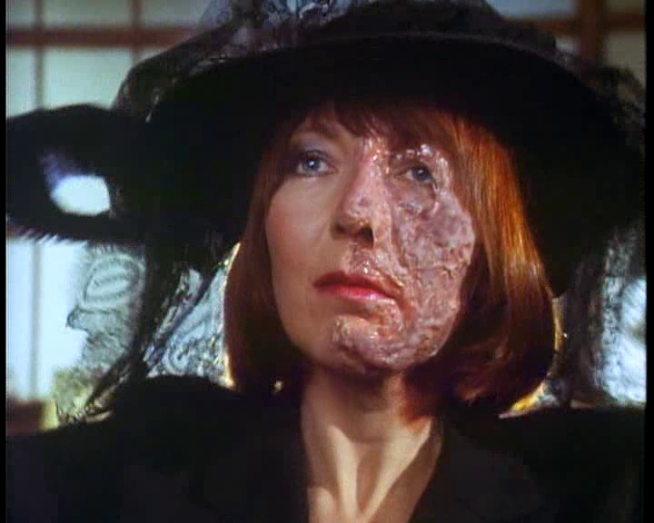 Dating with facial disfigurement