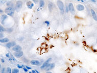 Immunohistochemical detection of Helicobacter (1) histopatholgy