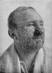 Smallpox IL1lg